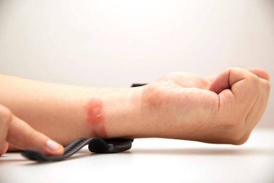 Watch Rashes:  How to Prevent Irritation from the Watch Strap